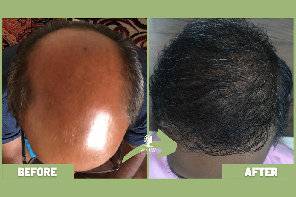 Hair Transplant India | Testimonials