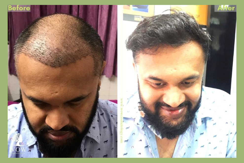 Hair Transplant India | Testimonials